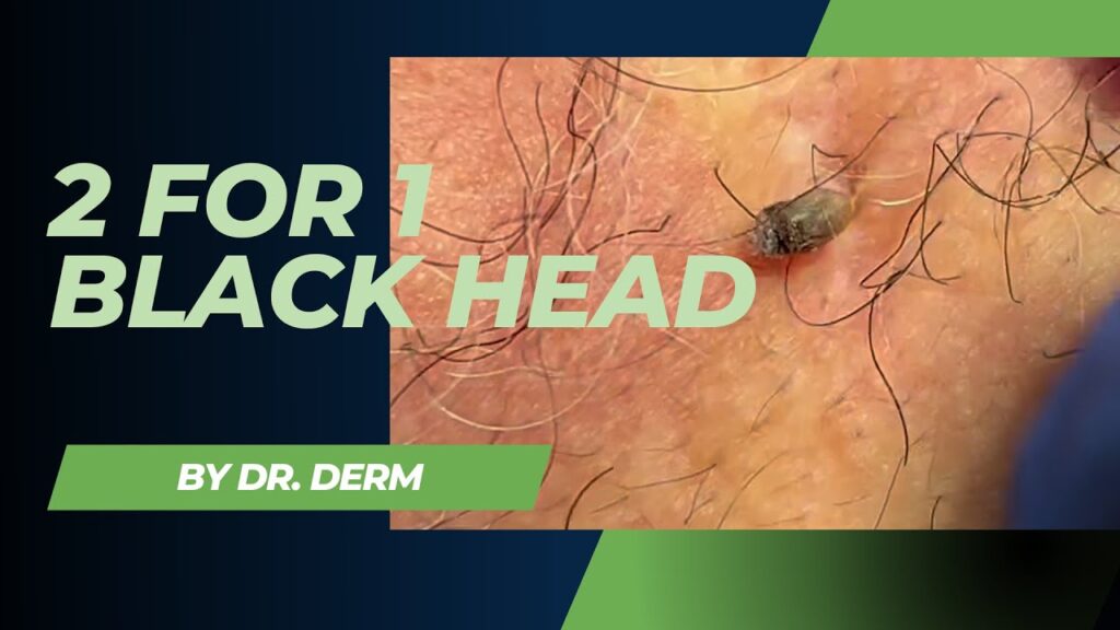 Blackhead - Dr Derm 2 Blackhead - Dr Derm 1