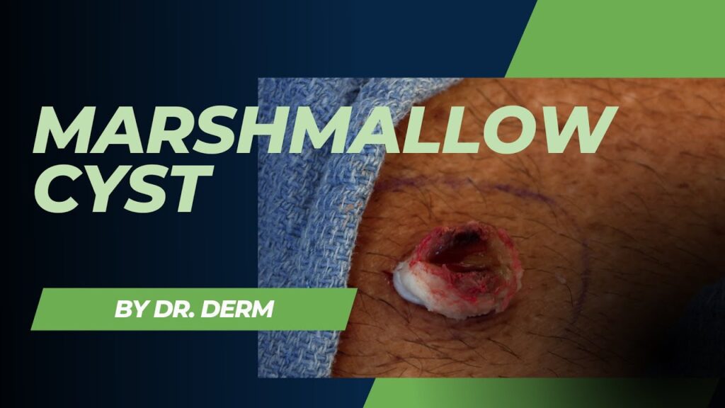 Cyst like a Marshmallow 1