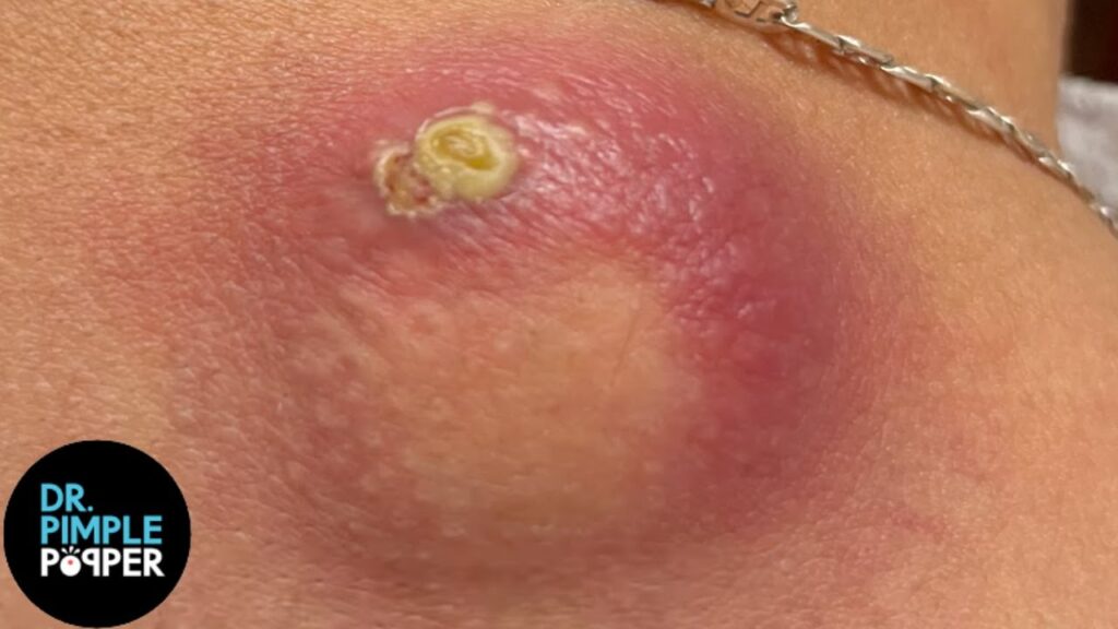 Massive Back Cyst 1
