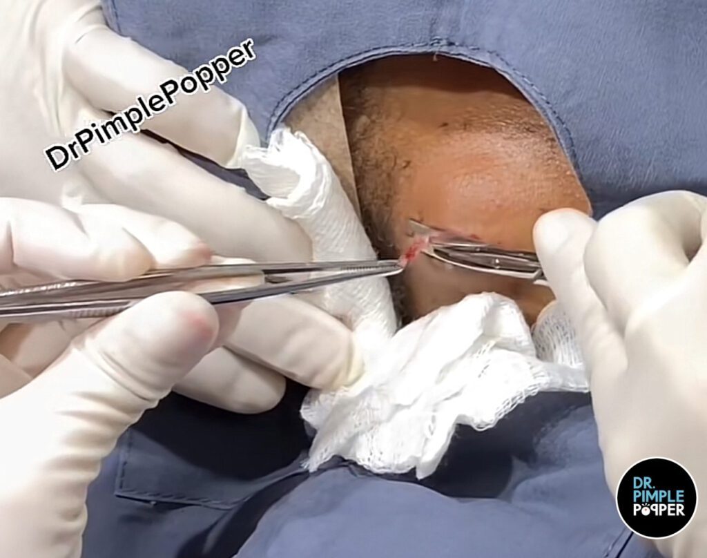 Unbelievable Cyst 1