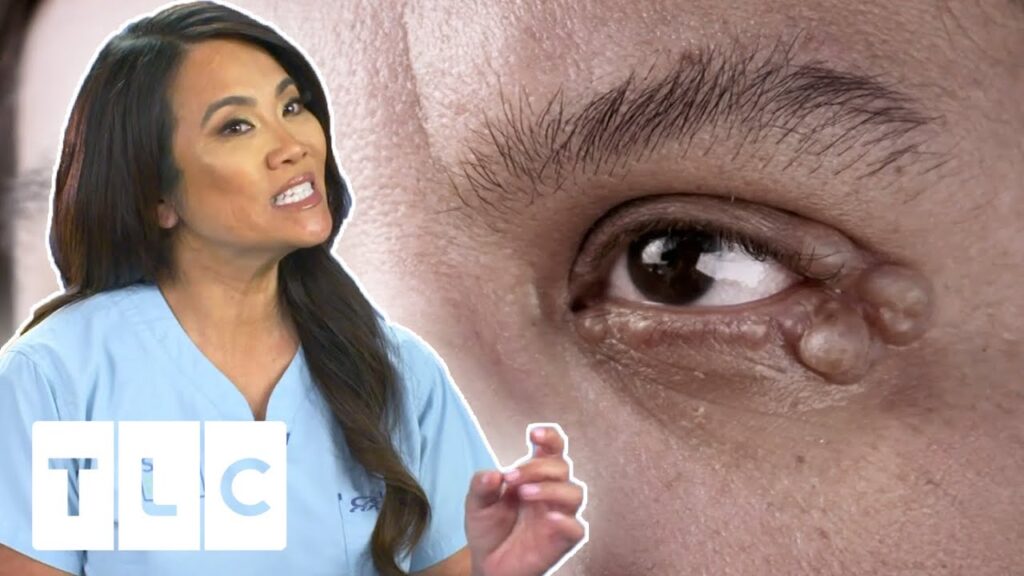 Eyelid Cyst 1
