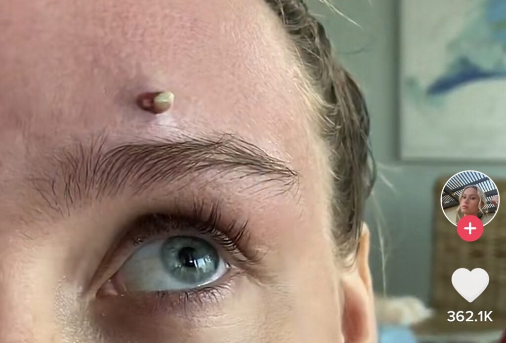Forehead Zit 1