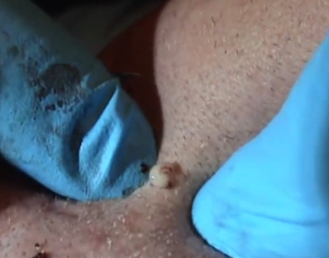 zit1