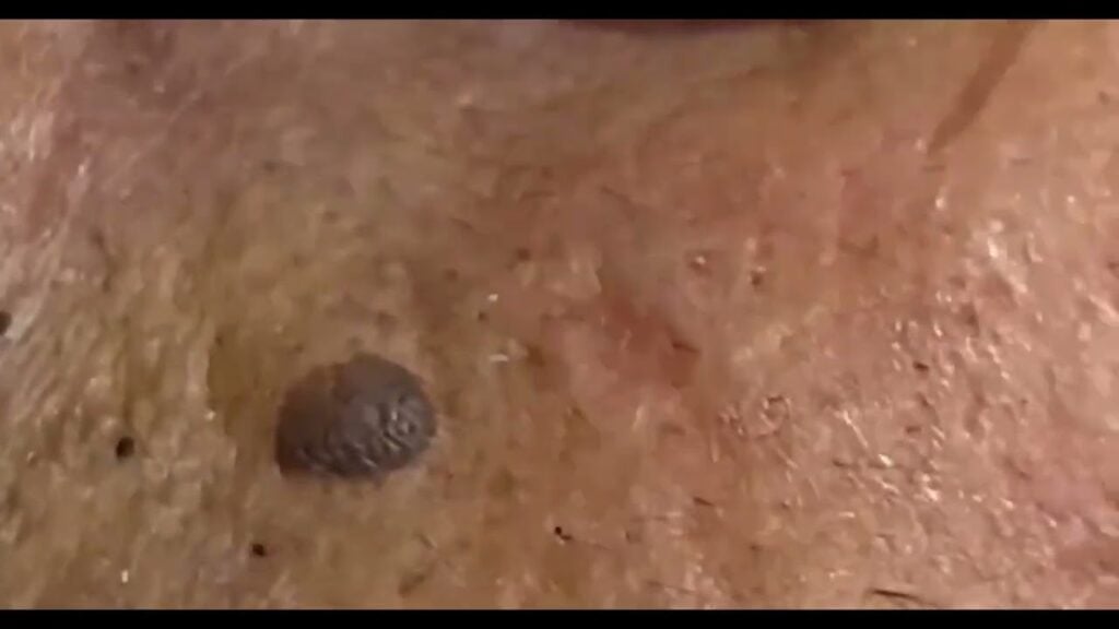 Extreme Blackhead Removal | For Stress Relief | Deep Pore Cleaning & Satisfying Extraction 1