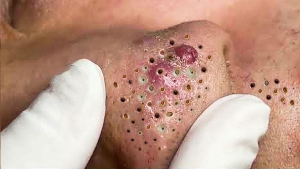 Extreme Blackhead Removal Satisfying Relaxing #1188 1
