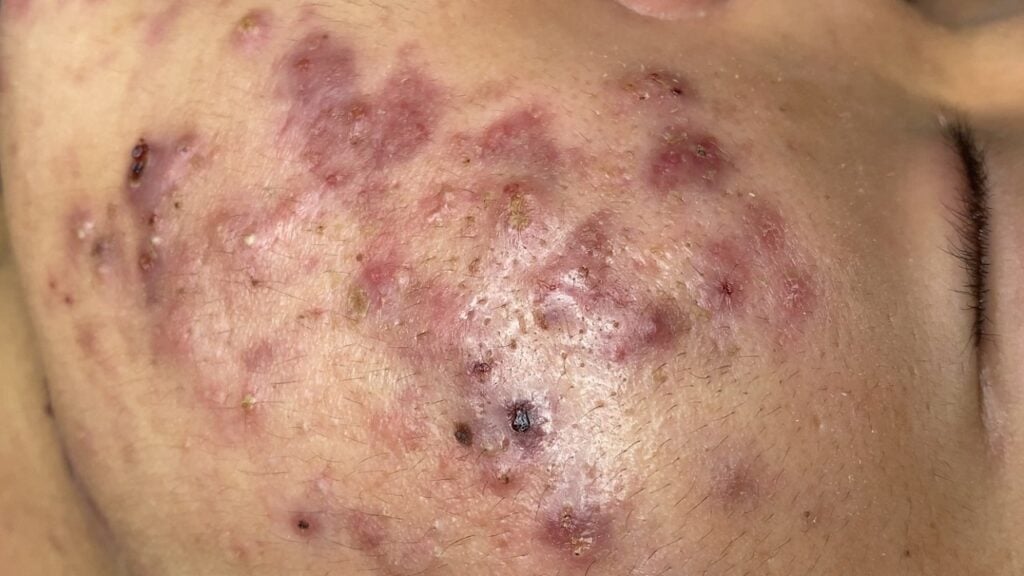 Relaxing Acne Treatment Session - SAC DEP SPA (Nhat, Part 3) 1