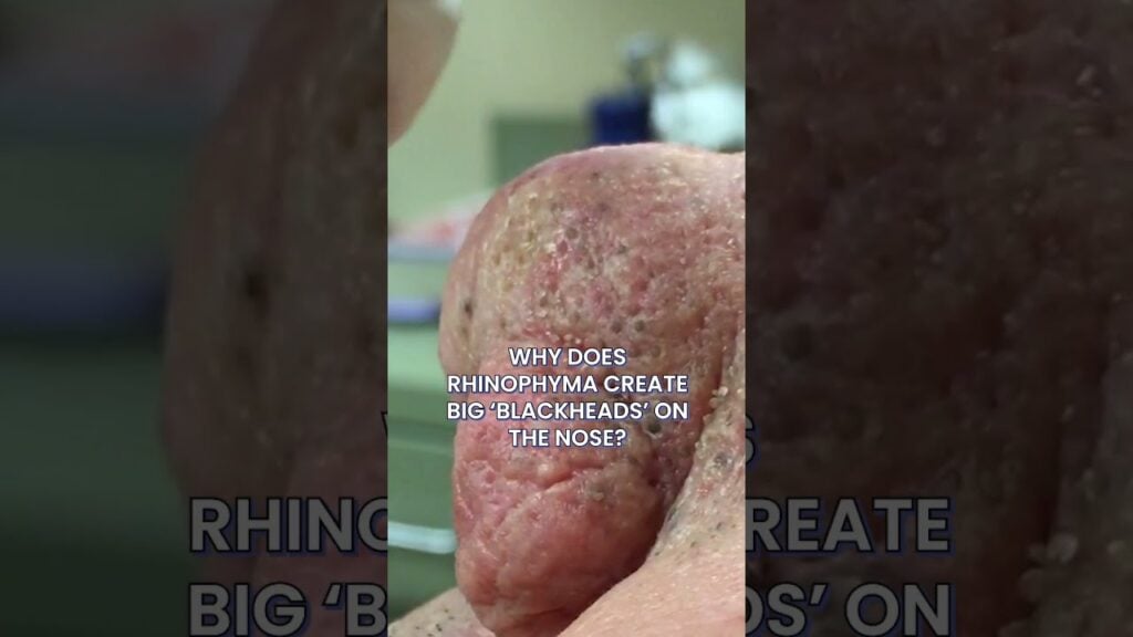 Big Blackheads On The Nose Can Be Caused By Rosacea? 1