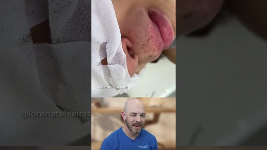 This lip line extraction is crazy 1