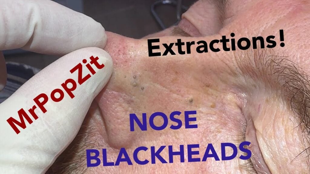 I exorcised the pores! This nose is clear. Deep nose extractions, can’t stop the pop! 1