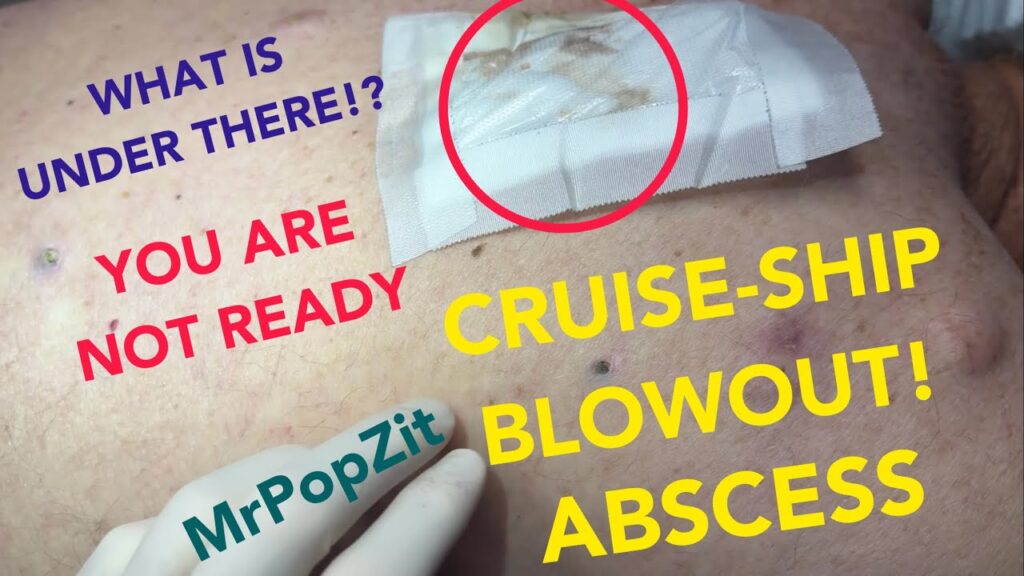 Cruise ship blowout!When I lifted the bandage I couldn’t believe how much had popped out!Get ready! 1