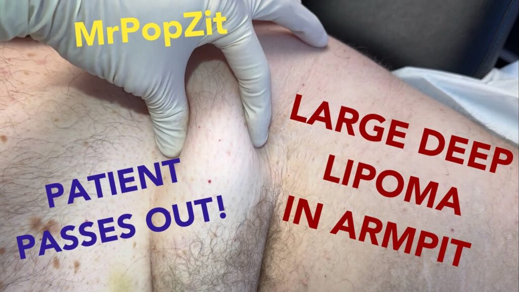 The “pass out” lipoma. Patient loses consciousness on the chair. Large deep axillary mass removed! 1