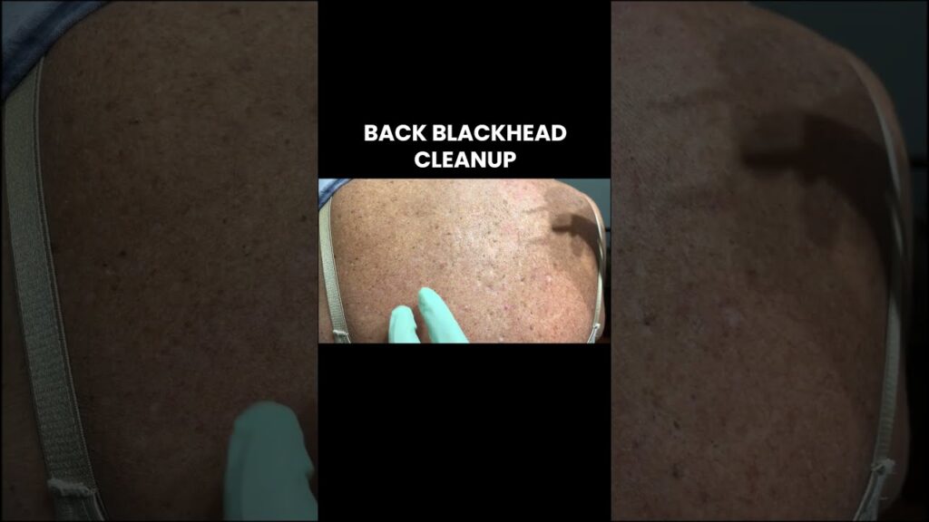 Back Blackhead Cleanup ✌️❤️💥 1