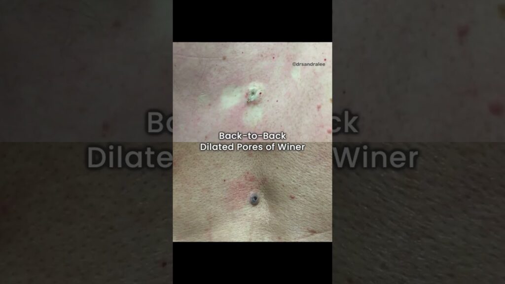 Two of my most famous Dilated Pores of Winer. Are one of these your fave, popaholics?⁠ 1