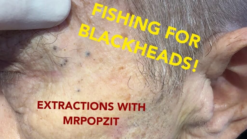 This one has it all!Blackheads,whiteheads,and a bonus Steatocystoma! See how I change it up! 1
