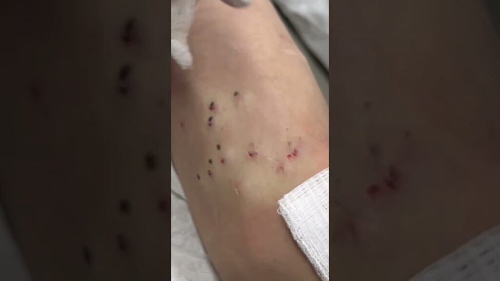 What is Steatocystoma Multiplex? | Dr. Pimple Popper vs. Steatocystomas 1