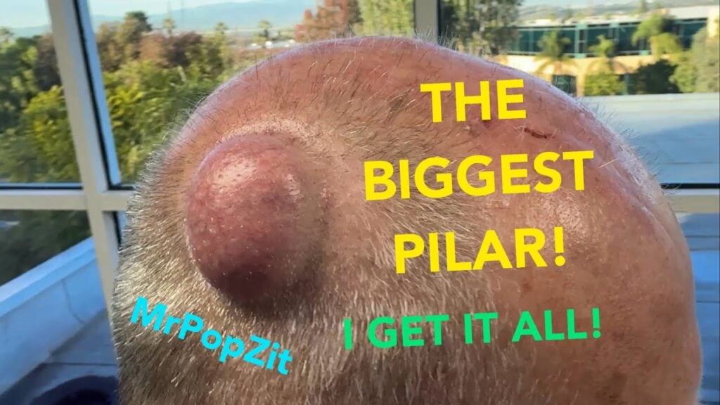 Gigantic Pilar Cyst! Don’t miss this one, it has it all! Unique secondary encapsulated lining. 1