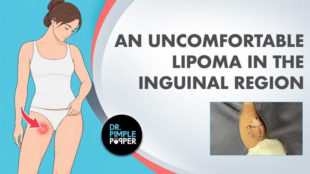 Dr. Pimple Popper vs. The Uncomfortable, Inguinal Lipoma 1
