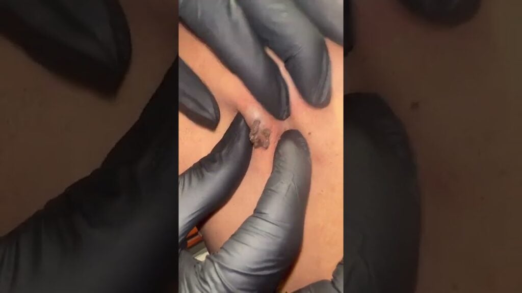 Deep Blackhead Removal Session - Basem Khaled 1