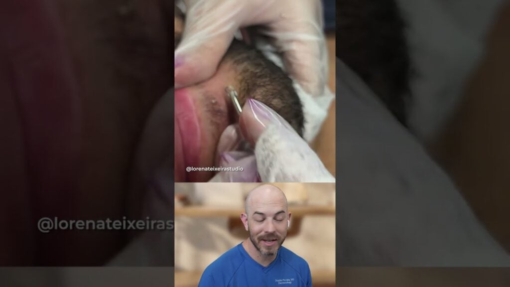Never squeeze sebaceous filaments 1