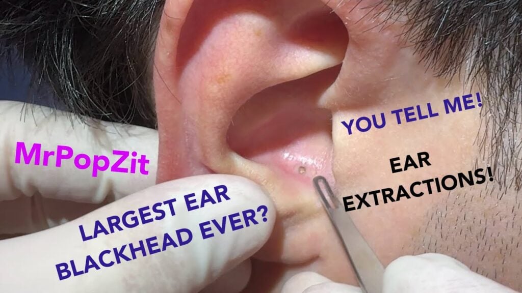 Giant ear blackheads extracted! There’s one triple pore one pocket! - difficulty level-Wizard 1