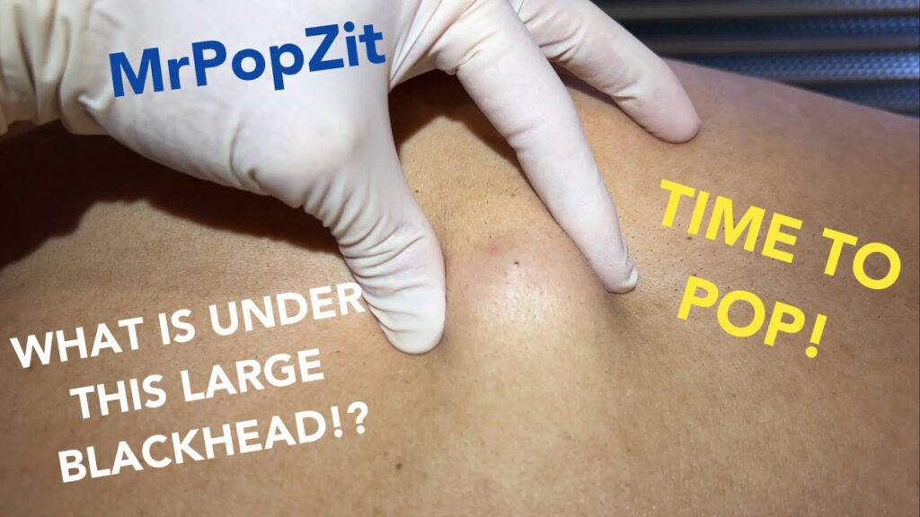 The Total Flake cyst. See the Fluffy POP! What has grown under that blackhead for all these years! 1