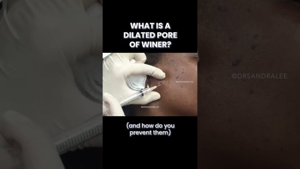 What is a Dilated Pore of Winer (and how do you prevent it?) 1
