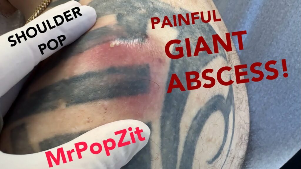 A VERY POPPY deep shoulder abscess drained! Put on your raincoat and come check it out! 1