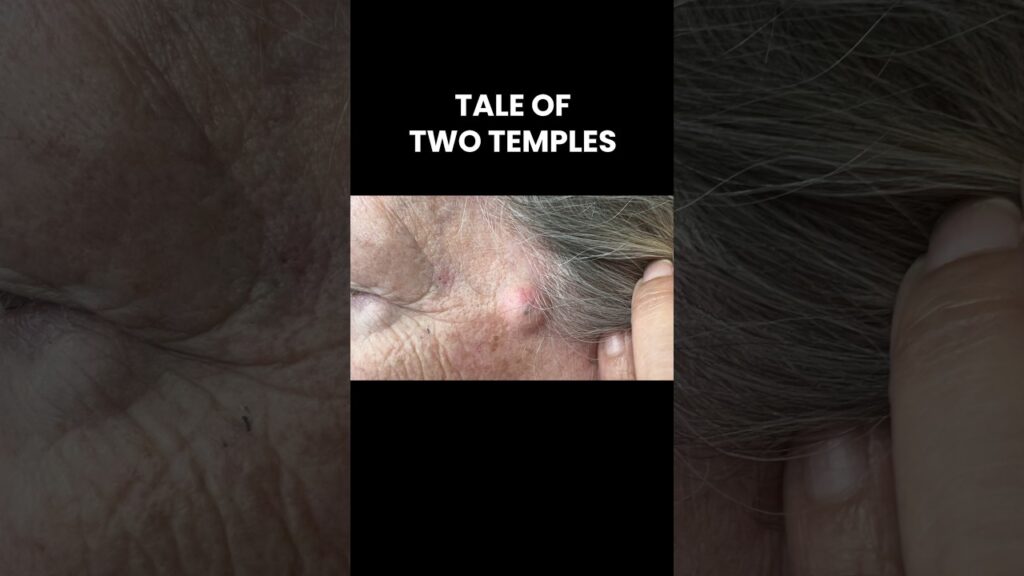 Two Cysts on Two Different Temples 👉💥👈 1
