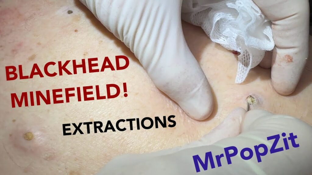 Gigantic Blackhead Minefield! Imbedded stones in the back with multiple cysts.Blackhead Extractions 1