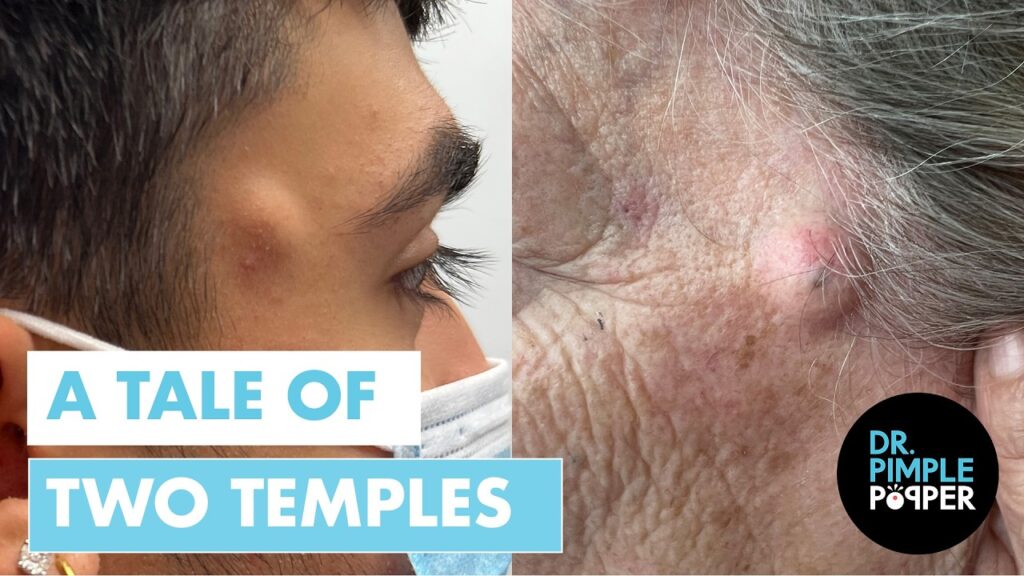 Dr. Pimple Popper vs. Two Temple Cysts 1