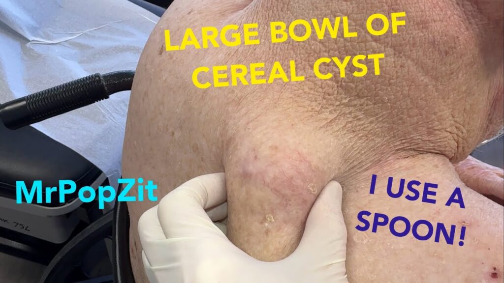 GIANT CYST removed with a spoon!Tricky removal with heart condition and wheelchair but I get it done 1