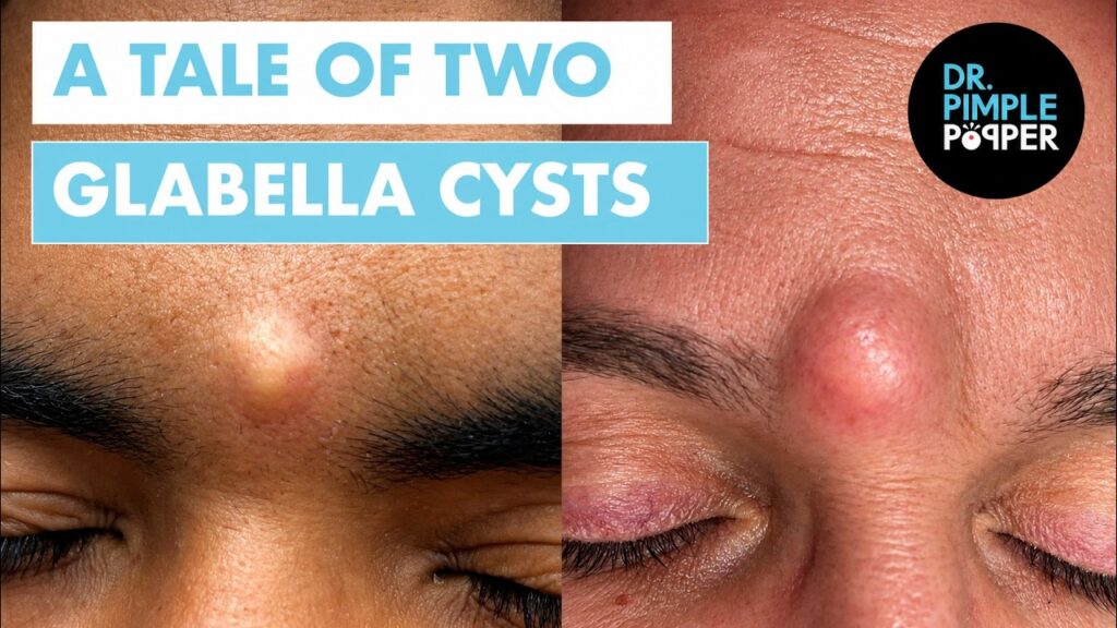 Dr. Pimple Popper vs. Two Glabella Cysts 1