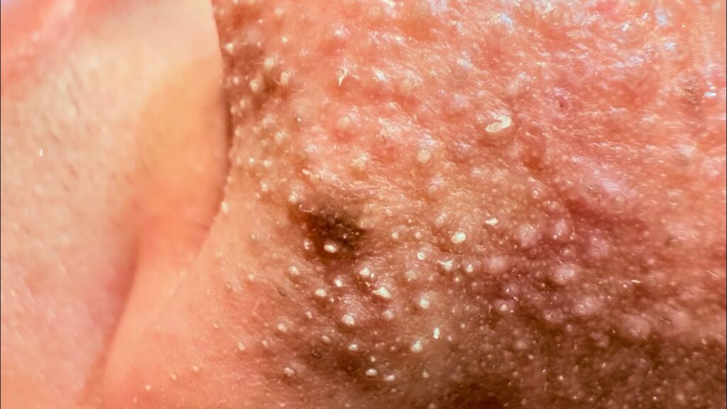 Live remove black head 1