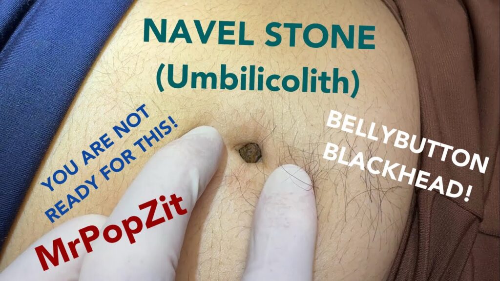 UMBILICOLITH!Giant bellybutton blackhead! Extremely rare to see! You won’t believe how deep it goes! 1