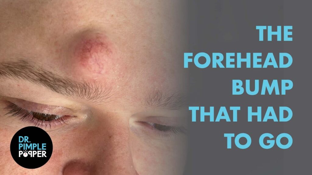 Dr. Pimple Popper vs. The Forehead Bump That Had To Go 1
