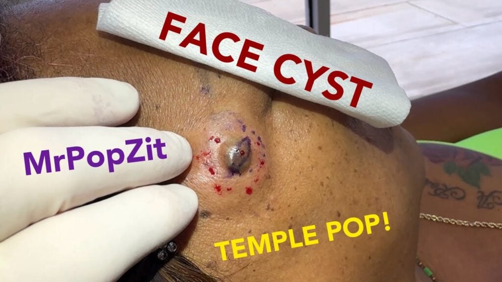 Cyst on face pops and is removed. Watch to the end and see her 1 week follow up and how it healed! 1