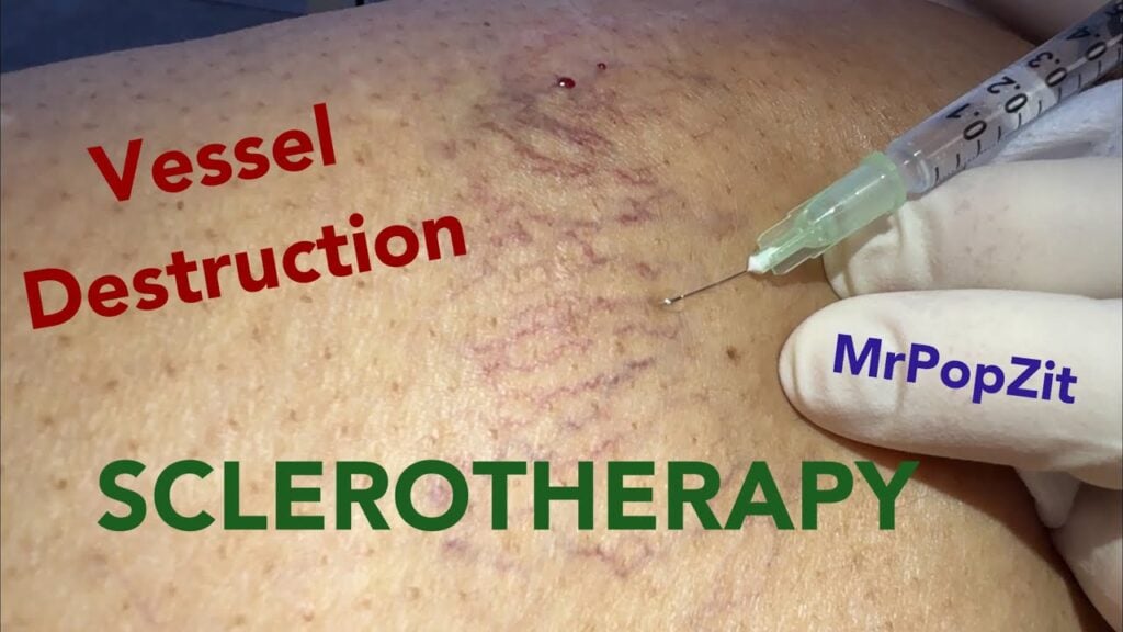 Spider veins can be so annoying,see how easy it is to destroy them!Steady hands and good eyes needed 1