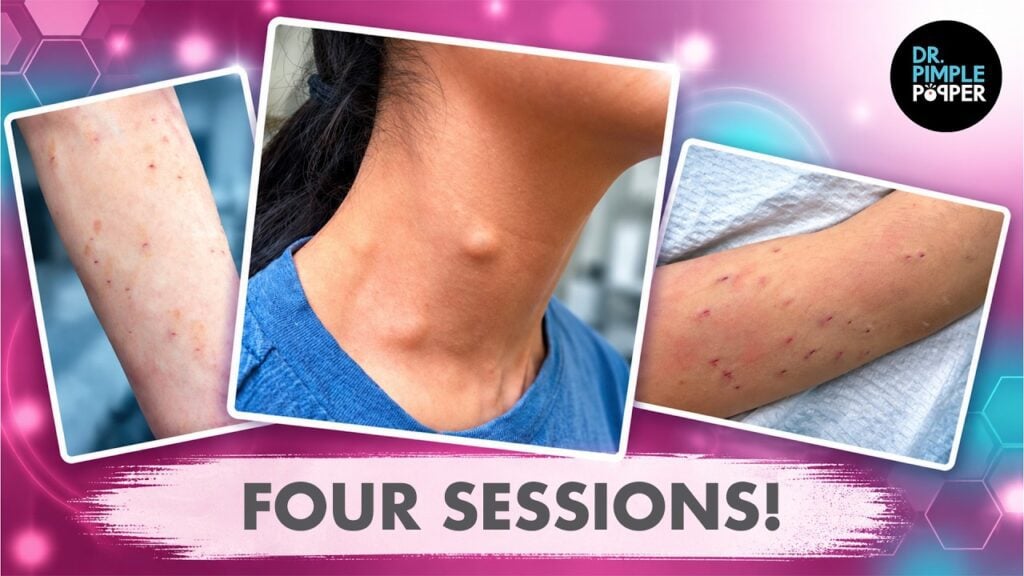 One Patient. 4 Steatocystoma Sessions. | Dr. Pimple Popper 1