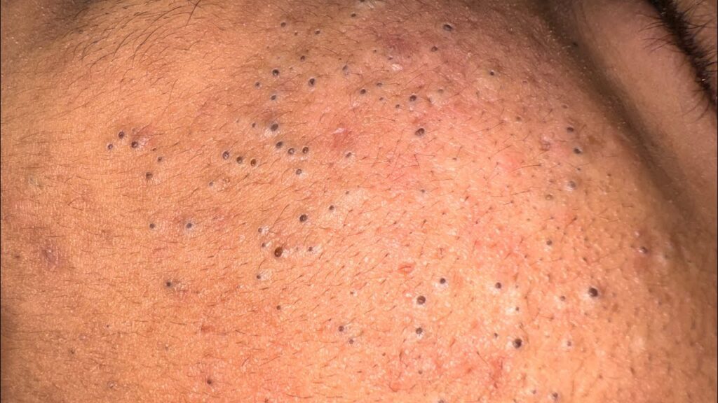 New part 1 tag removal black head 1