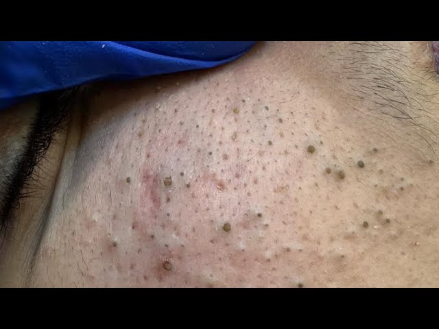 Deep Cleaning Blackheads: Professional Removal Routine 1