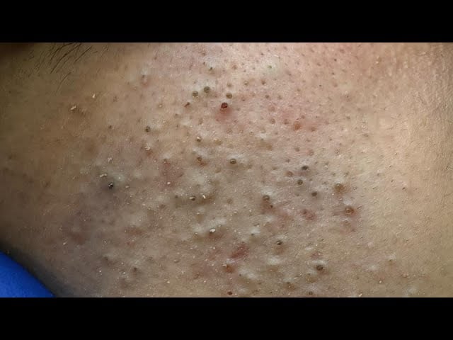Part (1)Ultra Satisfying Blackhead Removal Compilation | Daily Facial Care ASMR (Close-Up) 1