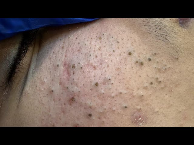 Deep Cleansing Techniques up-close pore sounds (wet and dry) 1