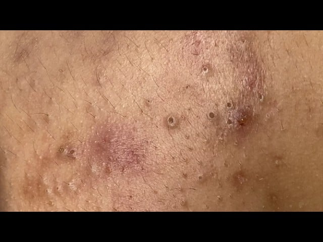 Full Acne Treatment Session - SAC DEP SPA 1
