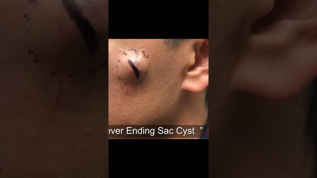 The Reveal Of This Massive Cyst Sac 1