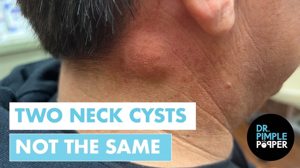 Two Neck Bumps vs. Dr. Pimple Popper | But They're NOT the Same! 1