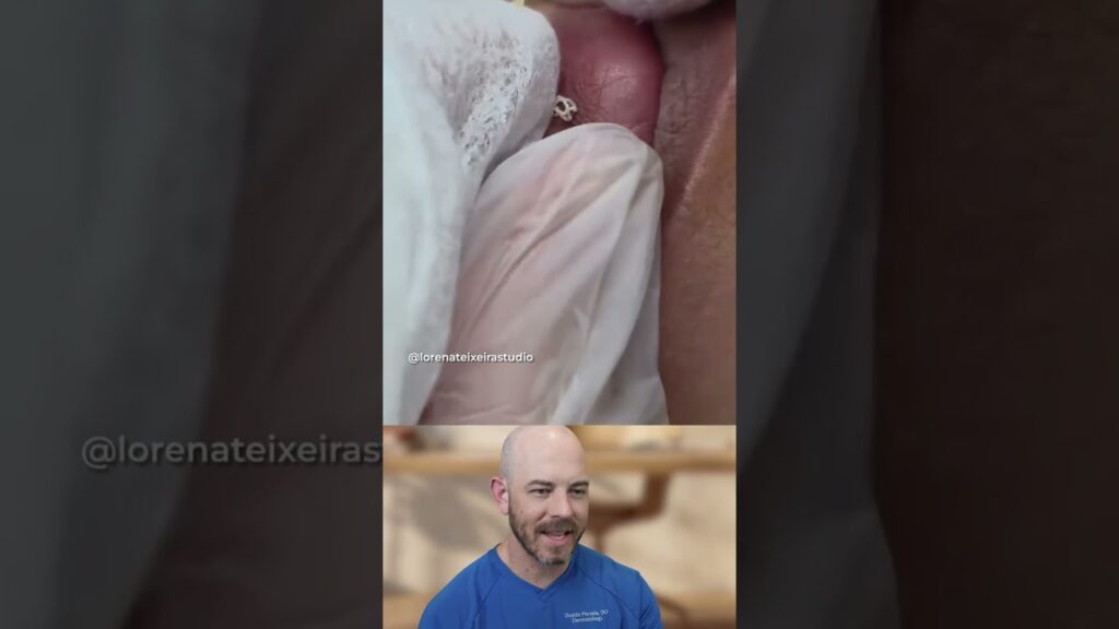 Lip line extraction 1