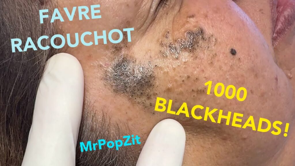 Get Ready for 1,000 blackheads extracted! Favre Racouchot. Excavating deep pore dirt! 1