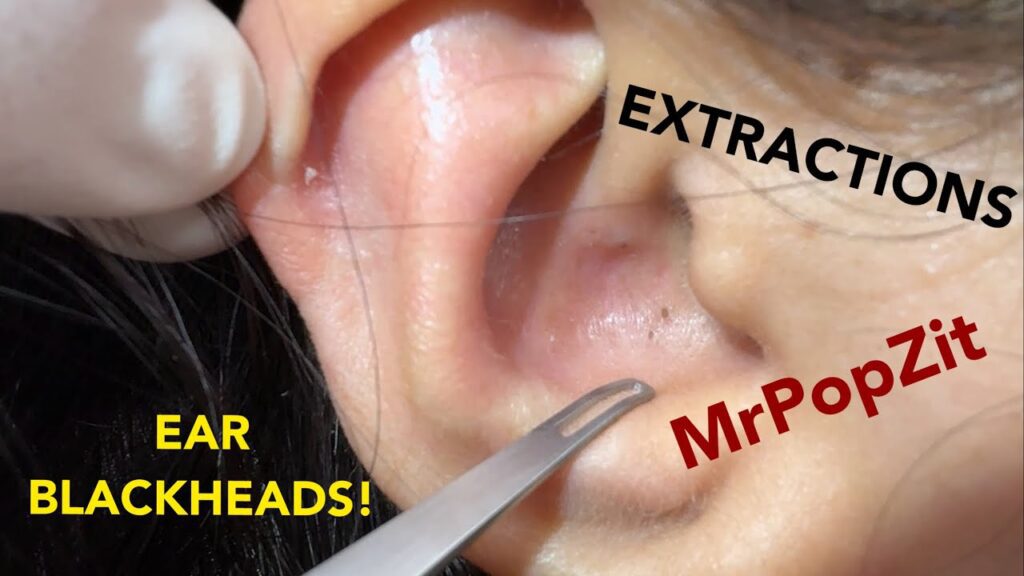 Very close up ear blackhead extractions. Front row seat to loop extractor technique for ear pops! 2 Very close up ear blackhead extractions. Front row seat to loop extractor technique for ear pops! 1