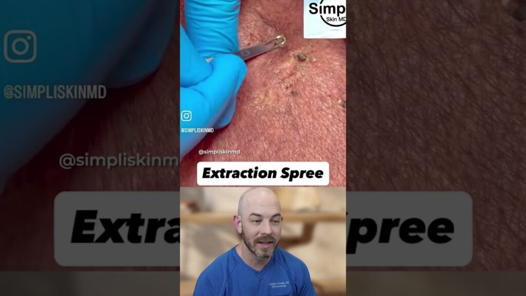My favorite type of extraction 1
