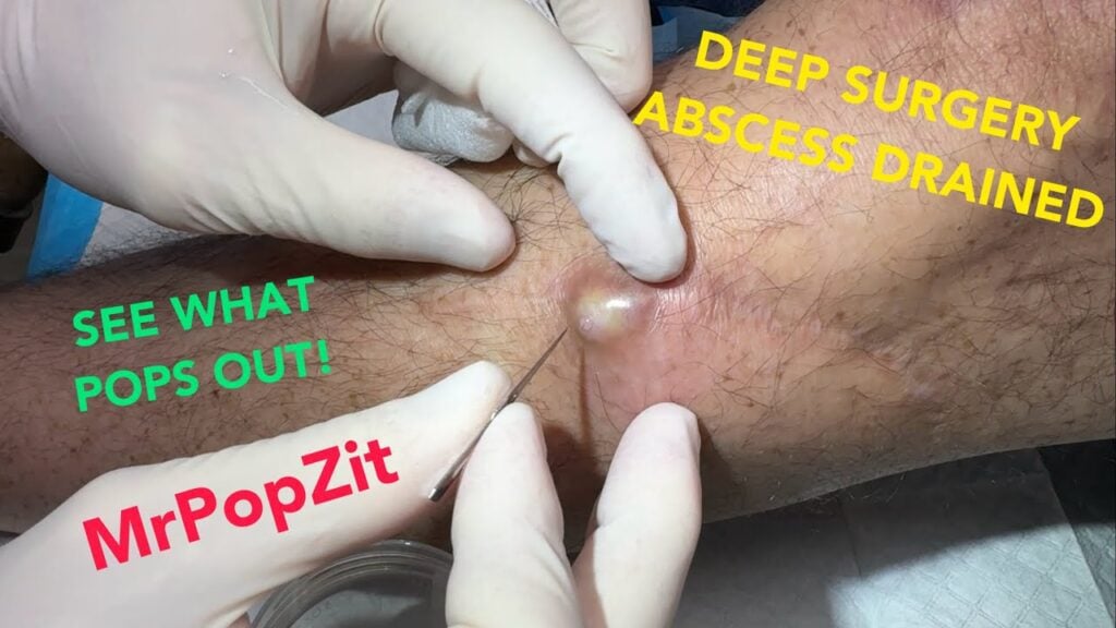 Motorcycle accident compound fracture repair abscess! Wait for what POPS out into my hands!! 1